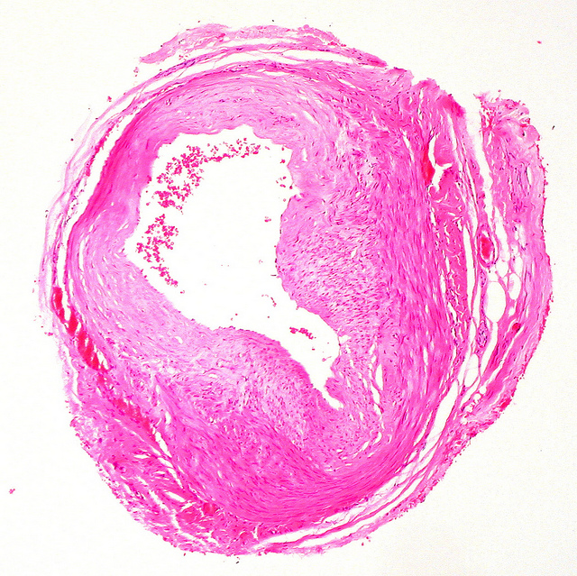 Temporal Artery Aneurysm, used under CC 2.0