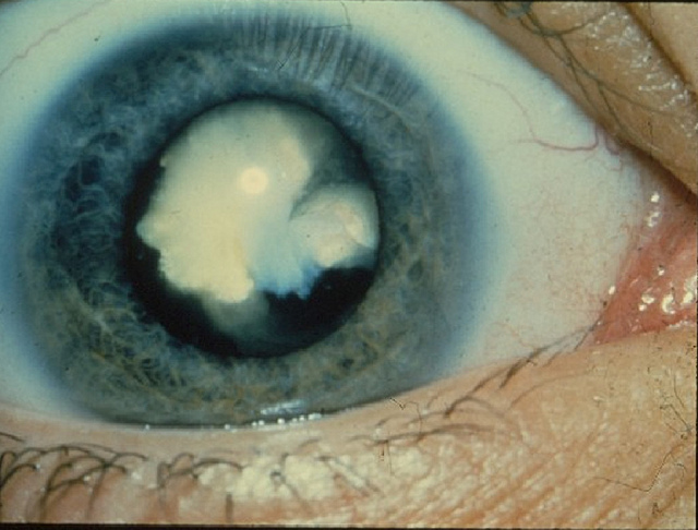 A diabetic cataract (Cataract, used under CC 2.0)